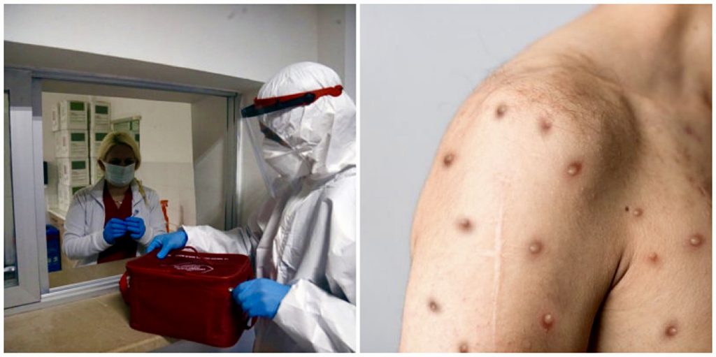 Oficial: Primul caz de variola maimuţei în România