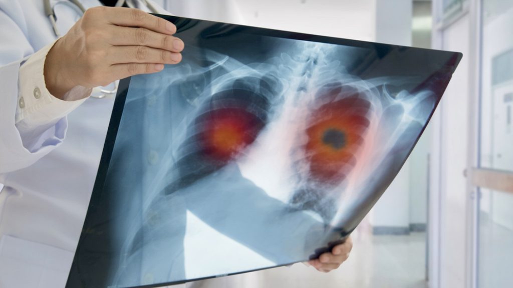 Gazul invizibil care poate provoca cancer pulmonar. Avertisment DSP Argeș